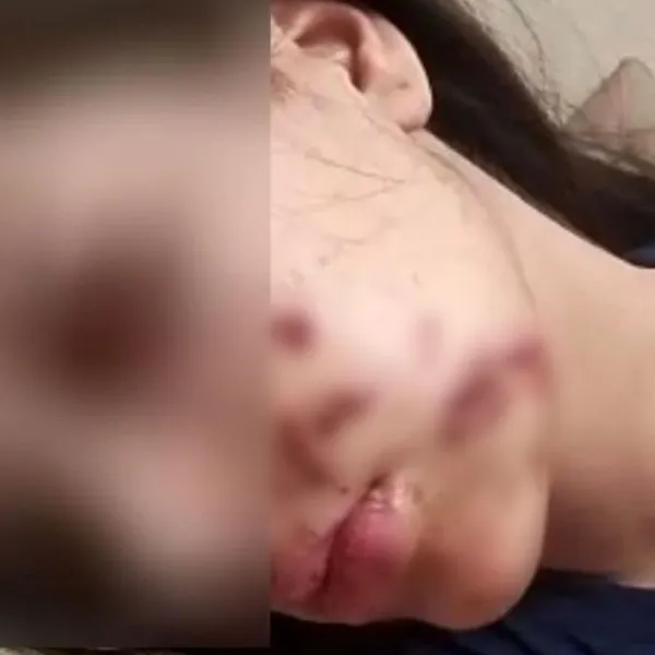 Torpil Faciası! Genç Kızın Yüzüne İnanılmaz Kaza